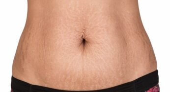 How to Get Rid of Stretch Marks Naturally – Top 10 Effortless Home Remedies