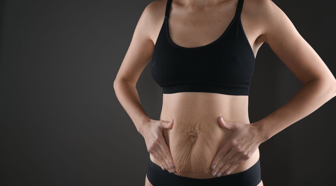 Tighten Stomach Skin After Weight Loss