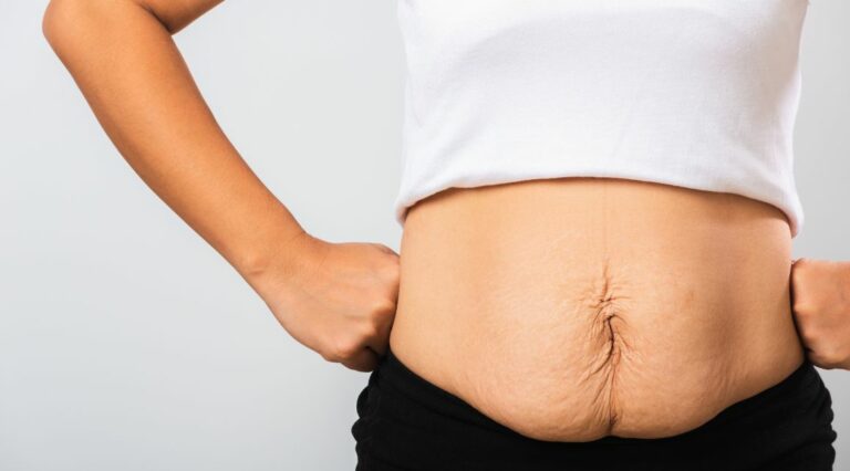 How To Fix Saggy Belly Skin After Baby